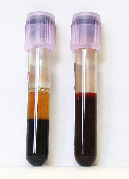 Blutproben, rechts frisch entnommen, links mit EDTA (Gerinnungshemmer) behandelt.