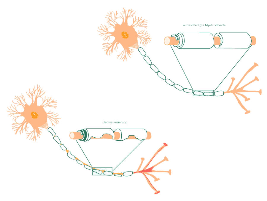 Demyelinisierung bei Multipler Sklerose