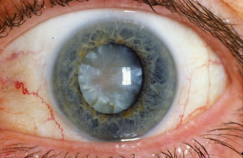 Grauer Star, Cataract, NIH